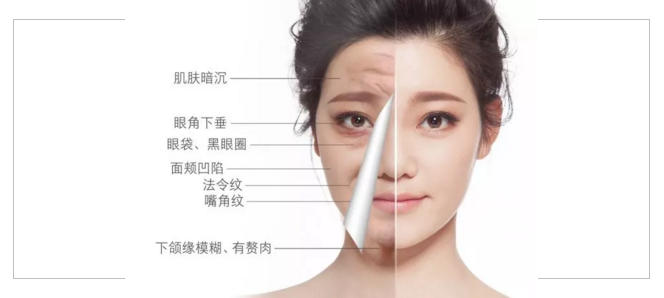 面部提升重返青春年华