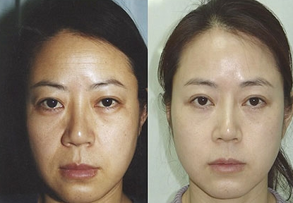 面部提升重返青春年华