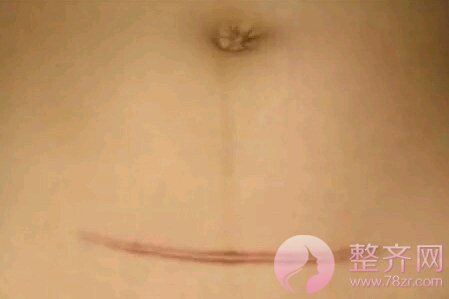 疤痕体质可以做微整形吗?如何判断自己是疤痕
