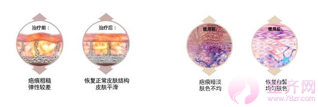 疤痕体质可以做微整形吗?如何判断自己是疤痕