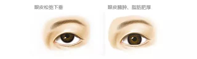 看完这个,终于知道为什么自己的双眼皮不好看