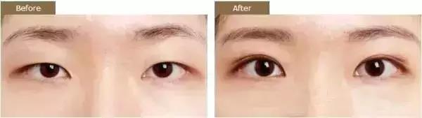 看完这个,终于知道为什么自己的双眼皮不好看