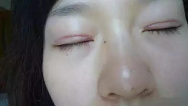 看完这个,终于知道为什么自己的双眼皮不好看