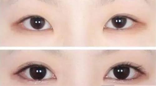 看完这个,终于知道为什么自己的双眼皮不好看