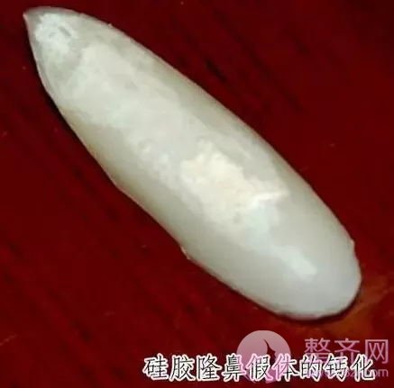 隆鼻假体可以取出来吗?