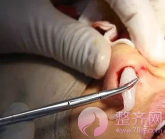 隆鼻假体可以取出来吗?