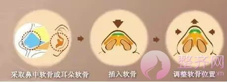 隆鼻假体可以取出来吗?