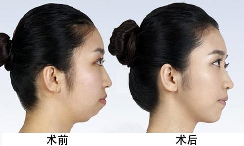 嘴凸不背锅,都是下巴惹的祸!