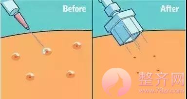 水光补水:这4种人千万别打!