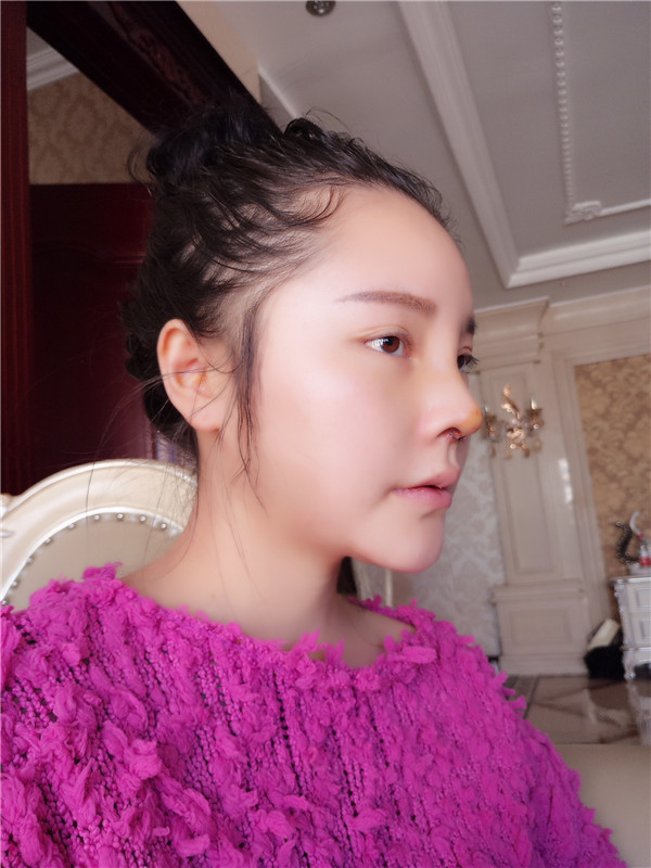 可爱的小仙女们,自从做了鼻部手术后,我觉得我在往网红的道路上越走越远了哈哈哈~~每天都是自拍自拍,进来看看我的美图案例吧!