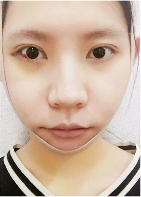 我的长曲线改脸型变V脸女神案例!!姐妹们,我之前的脸很长给人怪怪的感觉,现在也是一名小脸女神哈哈哈~~~
