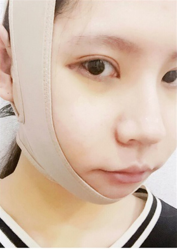 我的长曲线改脸型变V脸女神案例!!姐妹们,我之前的脸很长给人怪怪的感觉,现在也是一名小脸女神哈哈哈~~~