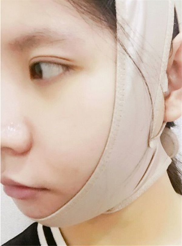 我的长曲线改脸型变V脸女神案例!!姐妹们,我之前的脸很长给人怪怪的感觉,现在也是一名小脸女神哈哈哈~~~