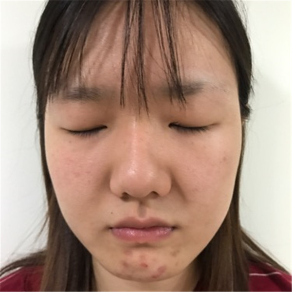 想做双眼皮的美女们进来看看我的案例吧!这里可以给你们很多参考哦~~我感觉我明明只是做了个双眼皮,却想变了个人一样!!