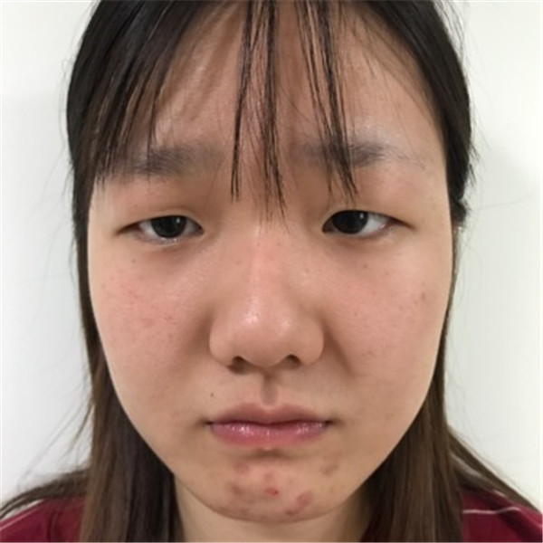 想做双眼皮的美女们进来看看我的案例吧!这里可以给你们很多参考哦~~我感觉我明明只是做了个双眼皮,却想变了个人一样!!