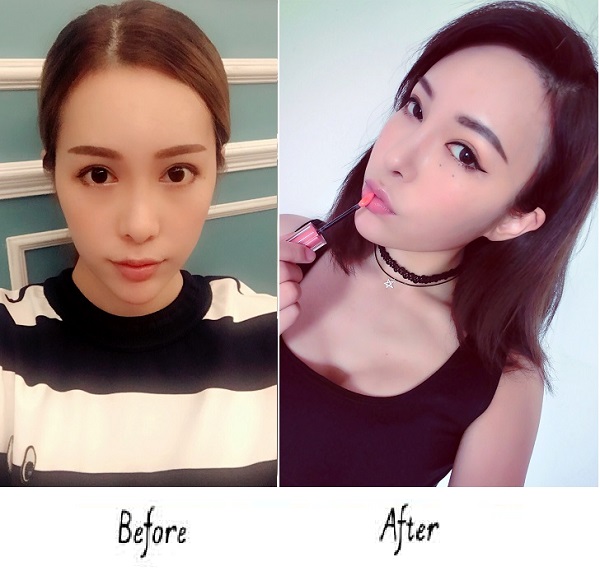 对于太阳穴凹陷,我们应该如何改变呢?