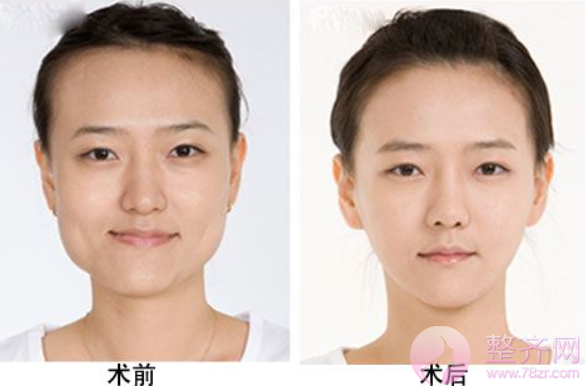 脸大应该怎么解决?