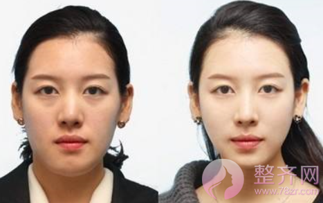 脸大应该怎么解决?