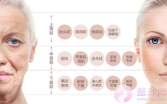12个问题让你了解埋线提升!