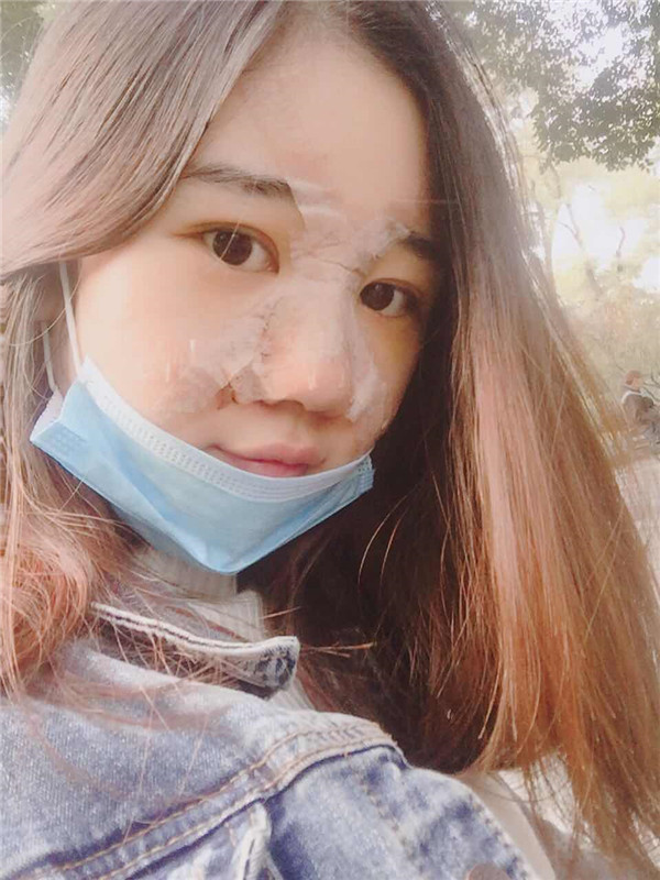 美女们,来看看我隆鼻的术前术后对比情况吧,是不是感觉变化好大!!可以为你们做做参考哦~~~