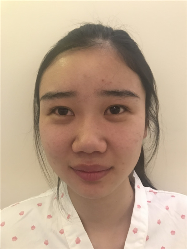 美女们,来看看我隆鼻的术前术后对比情况吧,是不是感觉变化好大!!可以为你们做做参考哦~~~