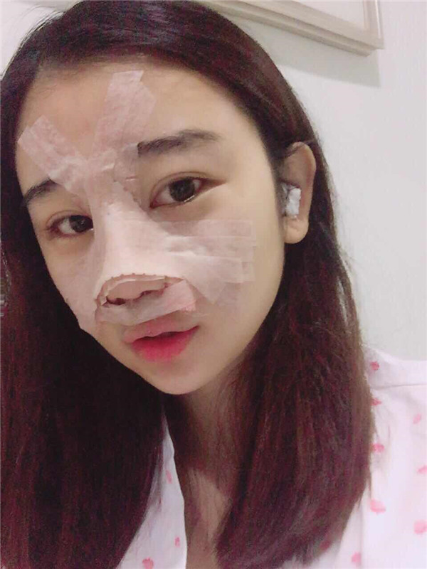 美女们,来看看我隆鼻的术前术后对比情况吧,是不是感觉变化好大!!可以为你们做做参考哦~~~