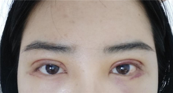 天气这么冷,我都不想敷面膜了~~~我来给姐妹们分享我的双眼皮变美经历啦!!!都进来看看我的案例吧~~有很多图片哦