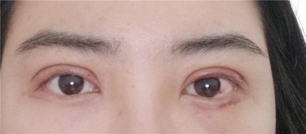 天气这么冷,我都不想敷面膜了~~~我来给姐妹们分享我的双眼皮变美经历啦!!!都进来看看我的案例吧~~有很多图片哦