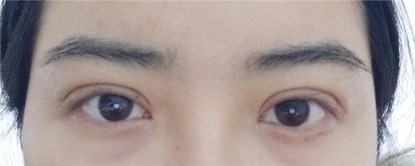 天气这么冷,我都不想敷面膜了~~~我来给姐妹们分享我的双眼皮变美经历啦!!!都进来看看我的案例吧~~有很多图片哦