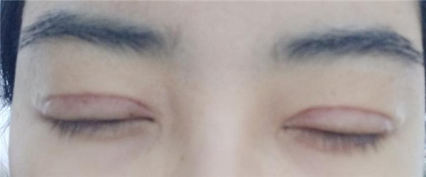 天气这么冷,我都不想敷面膜了~~~我来给姐妹们分享我的双眼皮变美经历啦!!!都进来看看我的案例吧~~有很多图片哦