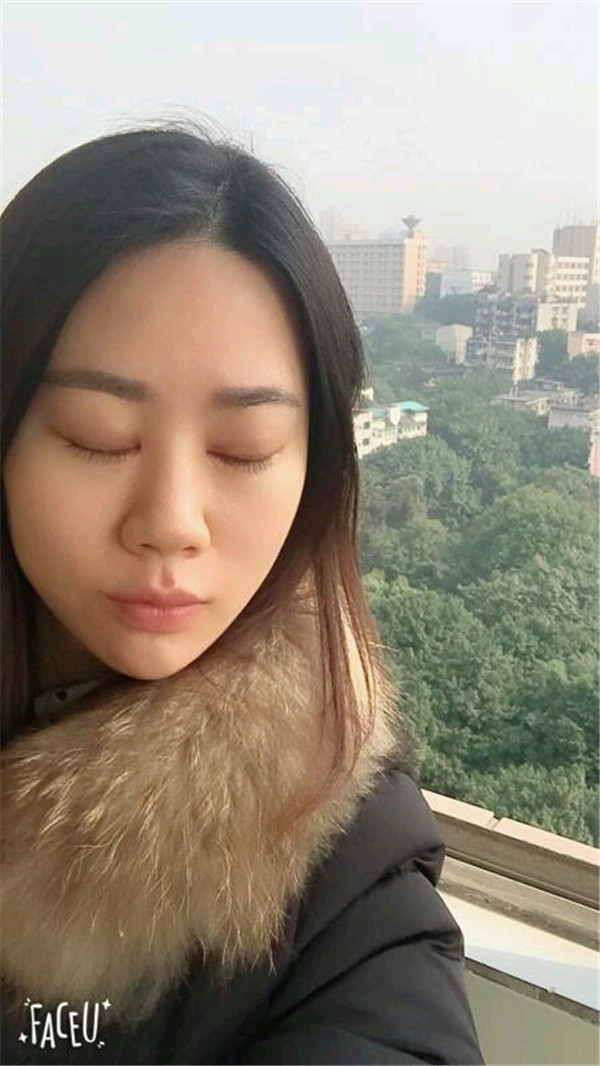 天气这么冷,我都不想敷面膜了~~~我来给姐妹们分享我的双眼皮变美经历啦!!!都进来看看我的案例吧~~有很多图片哦