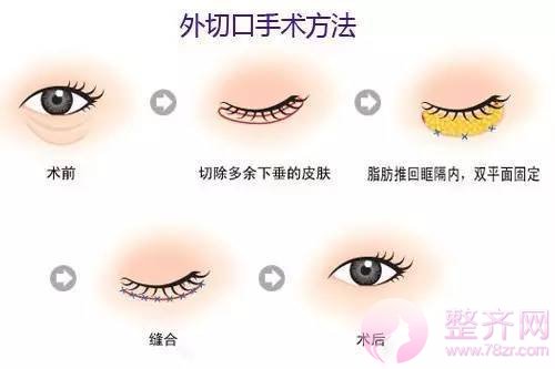 【hey朋友,你的眼袋就快能装下只袋鼠了】