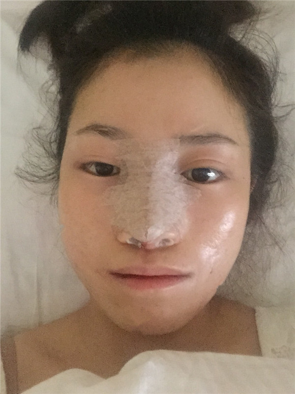 现在大众对整形的接受度越来越高了,我做了鼻部手术,我做的是偏自然的鼻子,来看看我的案例吧!!