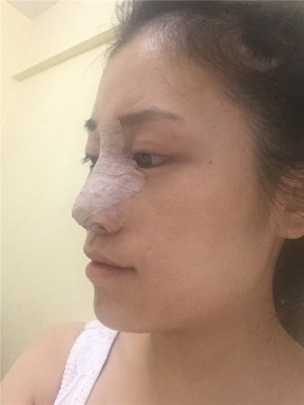 现在大众对整形的接受度越来越高了,我做了鼻部手术,我做的是偏自然的鼻子,来看看我的案例吧!!