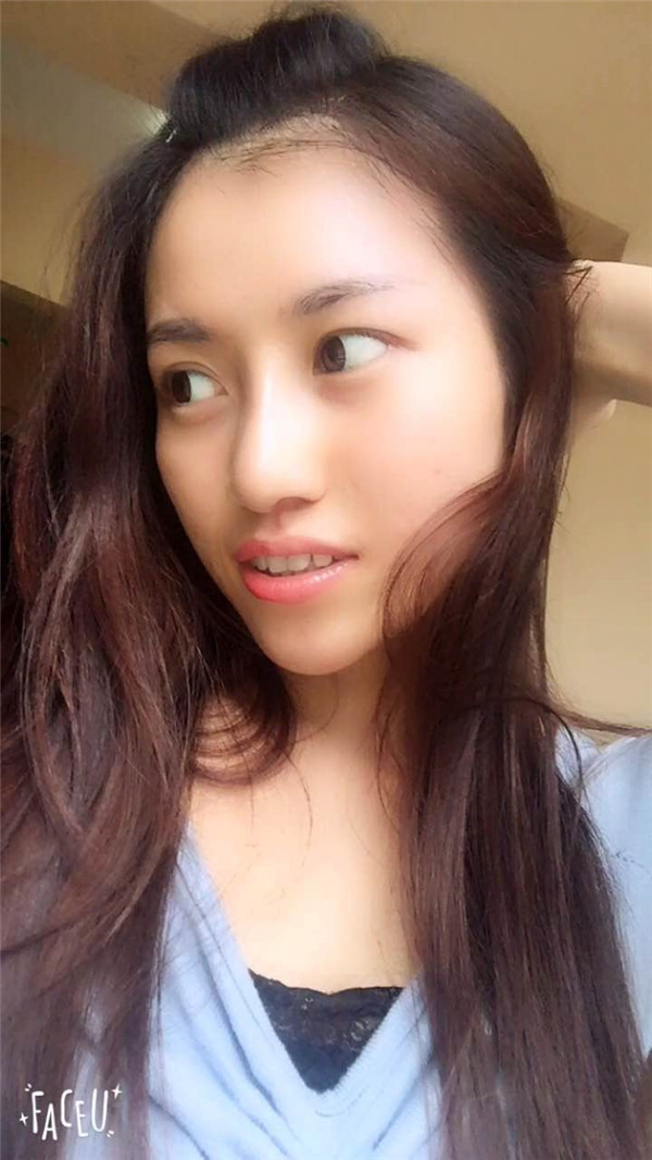 现在大众对整形的接受度越来越高了,我做了鼻部手术,我做的是偏自然的鼻子,来看看我的案例吧!!