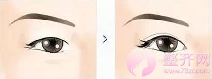 媚眼如丝,揭秘眼部整形的正确法则!