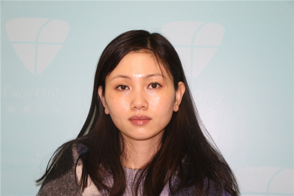 哈喽朋友们你们好,我刚做了自体脂肪填充脸部的手术,分享下我的历程,希望能帮助到有要了解这个项目的你们 ~~~