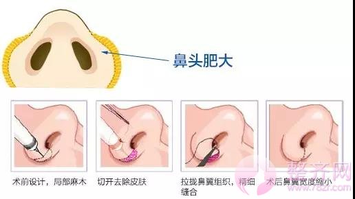 这些都不知道,你还隆什么鼻?