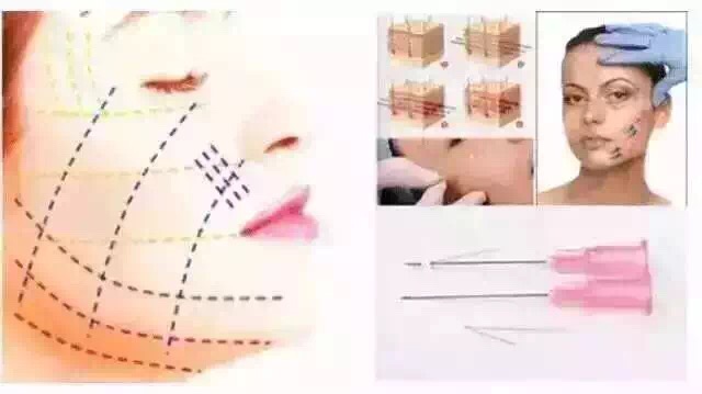 和你聊了三次埋线提升,你用9个字拒绝了