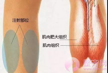 注射瘦脸不只瘦脸这一个功