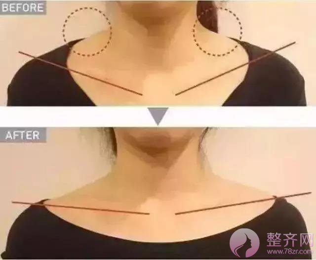 注射瘦脸不只瘦脸这一个功