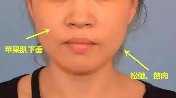 埋线提升,女人颜值的生命线!