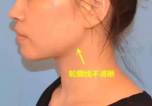 埋线提升,女人颜值的生命线!