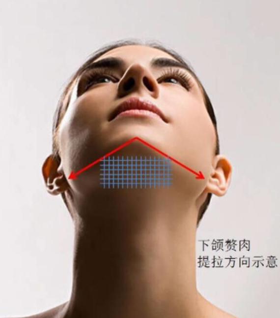 埋线提升,女人颜值的生命线!