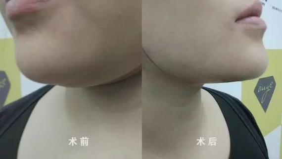 埋线提升,女人颜值的生命线!