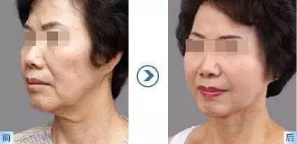 埋线提升,女人颜值的生命线!