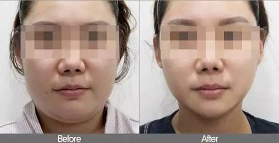 埋线提升,女人颜值的生命线!