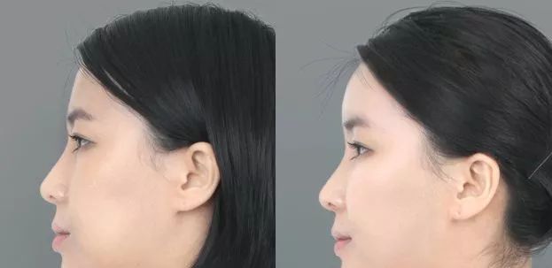 侧脸美的标准是什么?