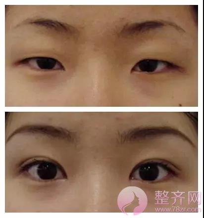 如何有一对令人羡慕的双眼皮!