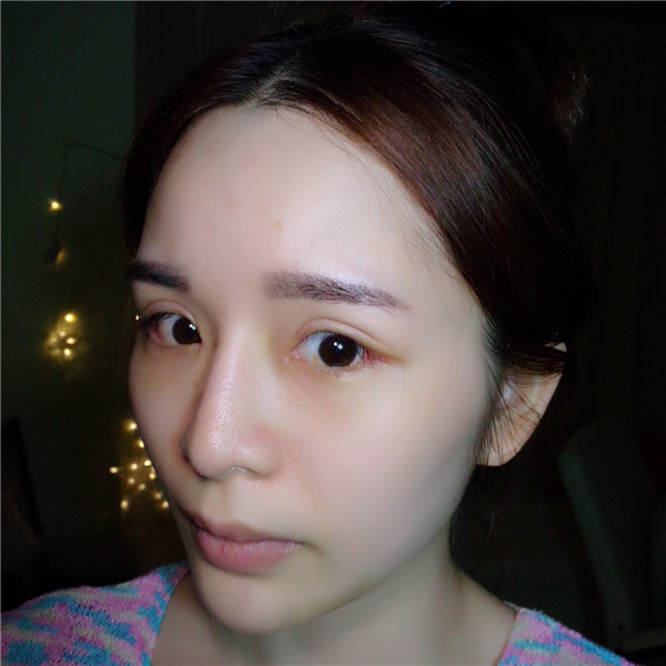 【双眼皮手术】终于去做了心心念念的双眼皮手术啦~~来看看我的案例吧!我没开眼角哦,宝宝们你们开眼角了没?
